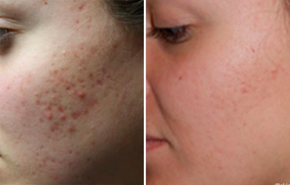 acne scar reduction