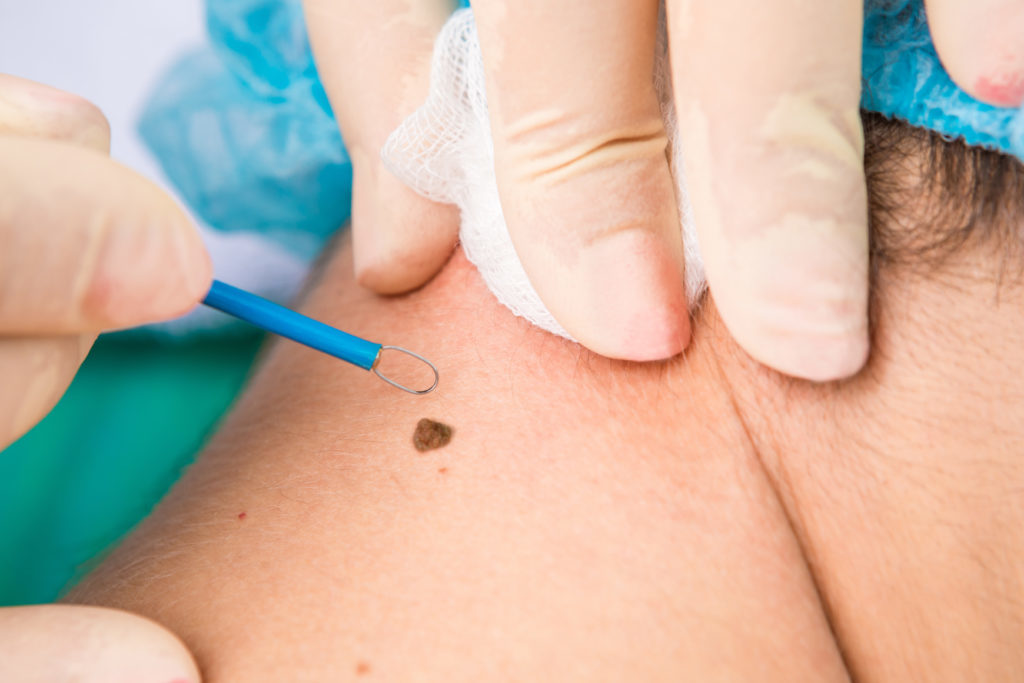 Mole Removal